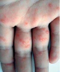 Фото 2. Болезнь «рук, ног и рта»