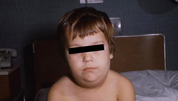 Симптомы паротита