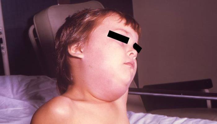 Припухлость в области шеи